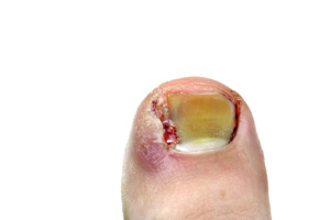 Derm Dx: Thickened toenails - Clinical Advisor