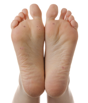 Verruca foot sole
